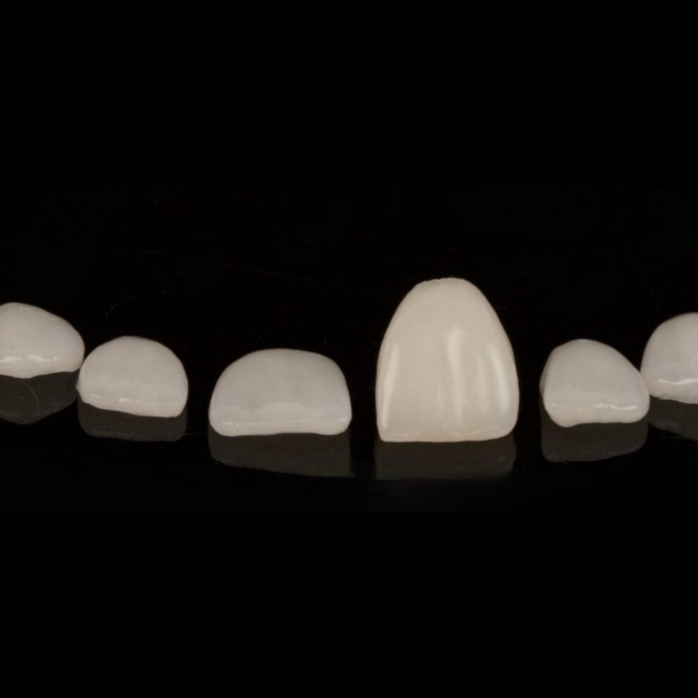 Guía Completa sobre Carillas Dentales