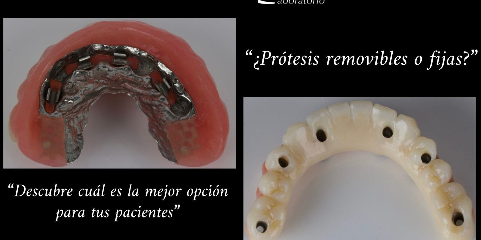 protesis_removibles_o_fijas