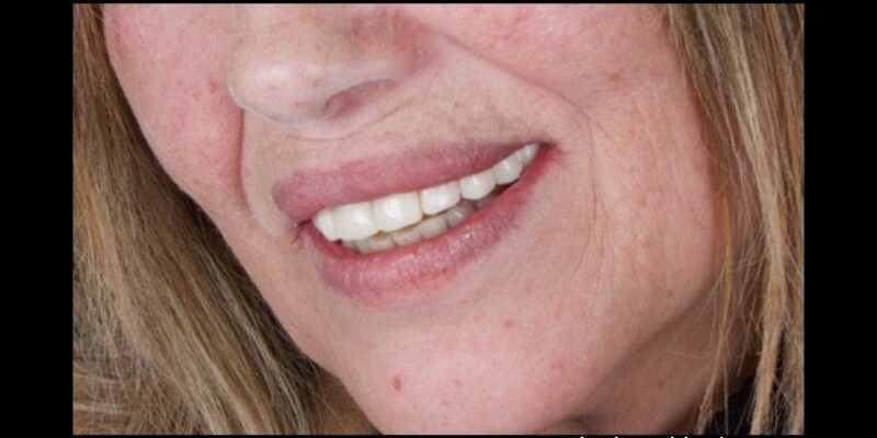 optimizarProtesisTemporales