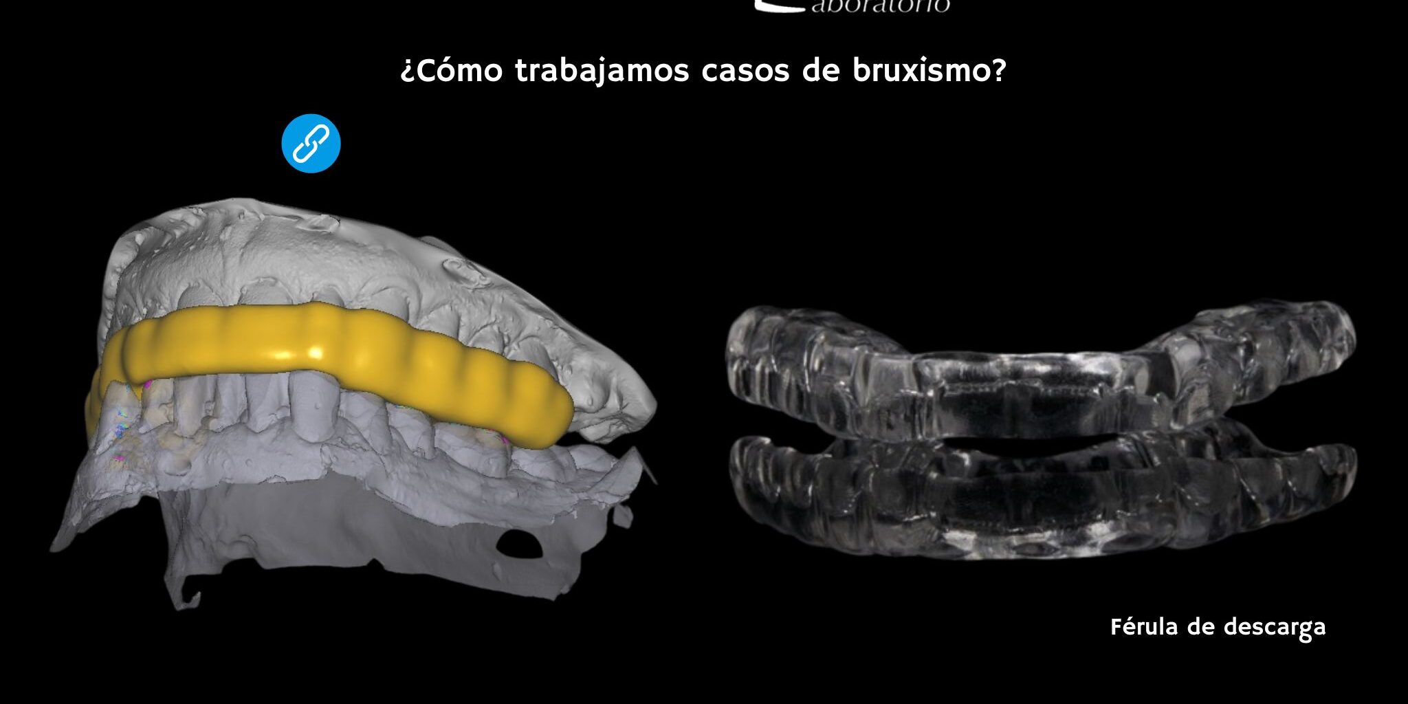 Post Prótesis dentales para pacientes con bruxismo recomendaciones y materiales. BlogDL