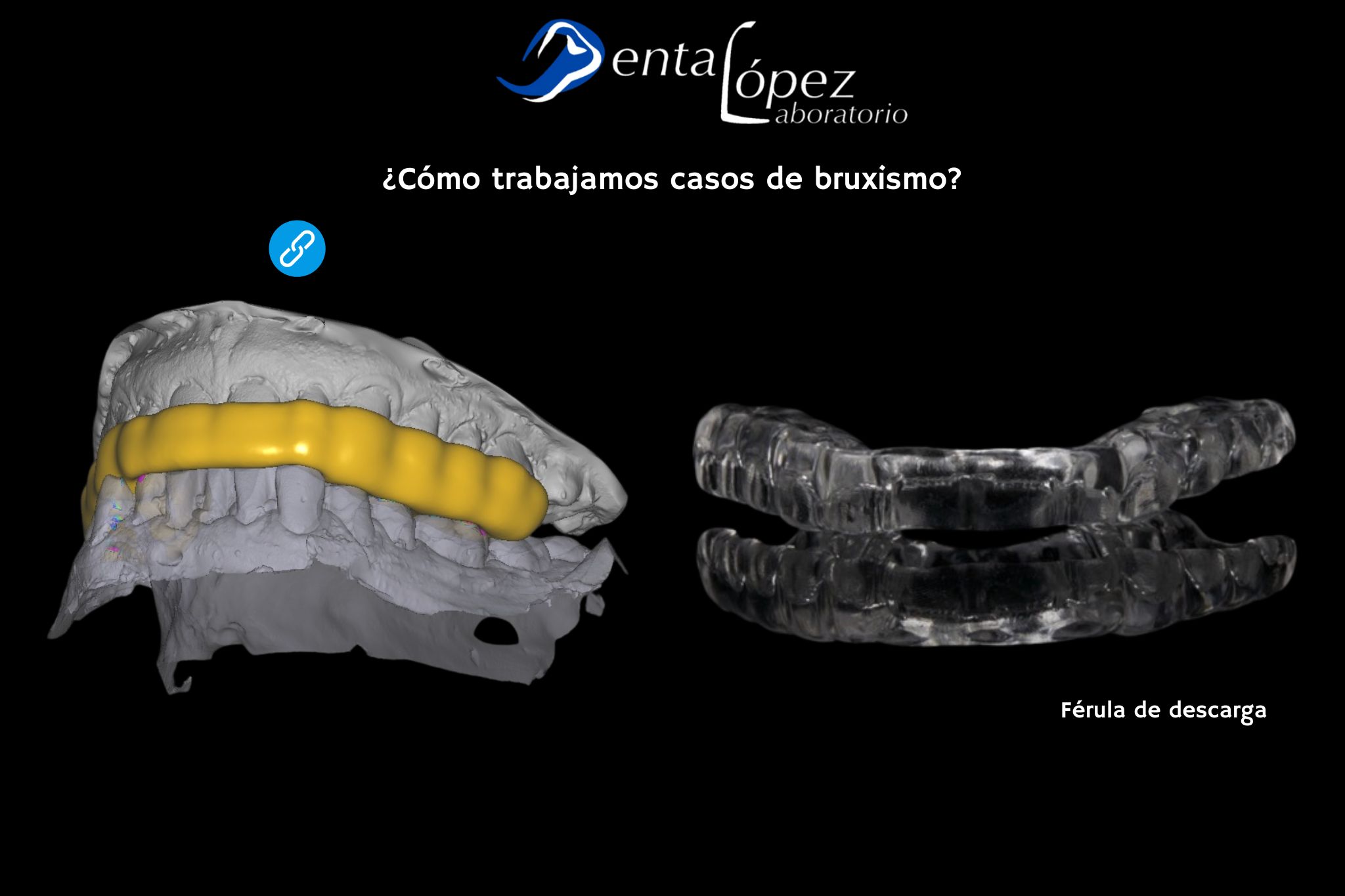 Post Prótesis dentales para pacientes con bruxismo recomendaciones y materiales. BlogDL