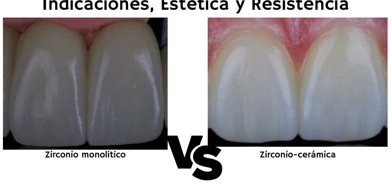 Zirconio Monolítico vs. Estratificado- Indicaciones, Estética y Resistencia