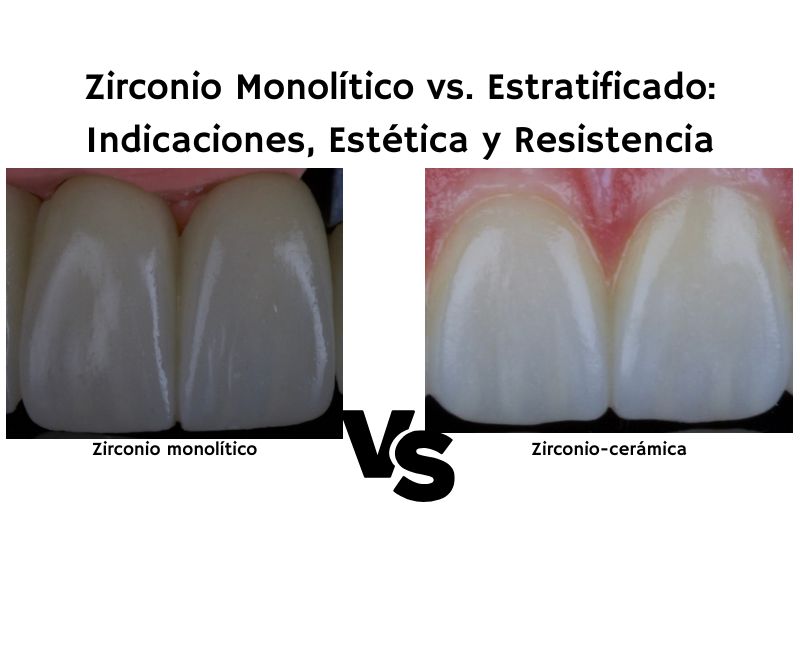 Zirconio Monolítico vs. Estratificado- Indicaciones, Estética y Resistencia