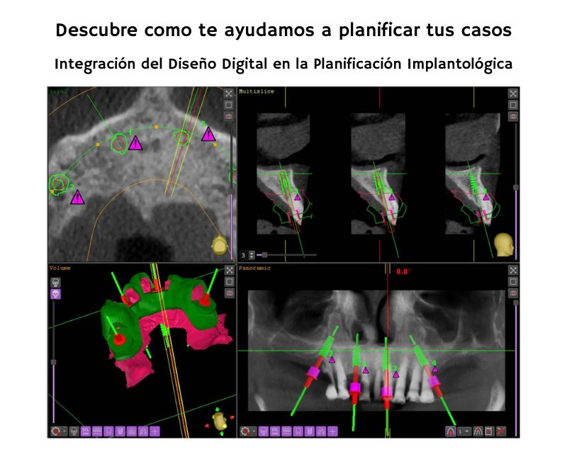 Integración del Diseño Digital en la Planificación Implantológica