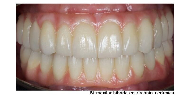 La Importancia del Sellado Marginal- Qué Esperar del Laboratorio