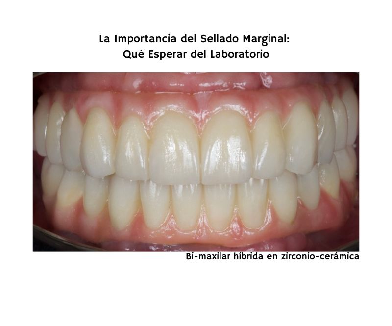 La Importancia del Sellado Marginal- Qué Esperar del Laboratorio