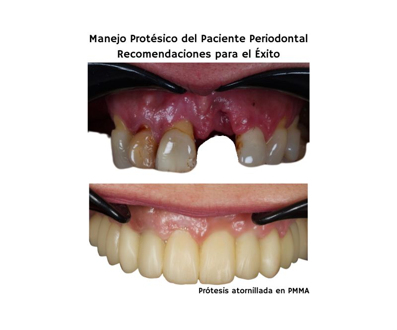 Manejo Protésico del Paciente Periodontal Recomendaciones para el Éxito