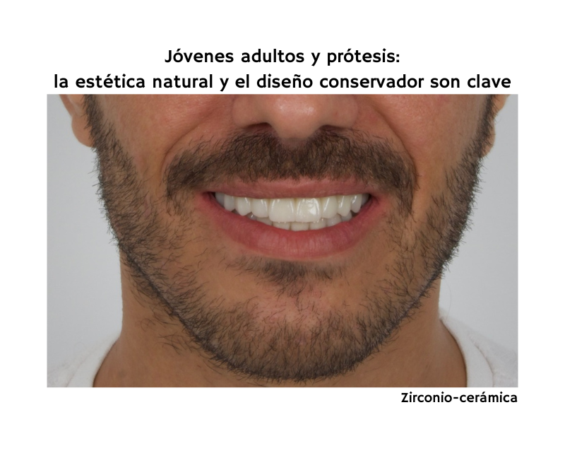 Prótesis para Jóvenes Adultos- Estética Natural y Diseño Conservador. Cómo adaptar los diseños a pacientes que priorizan la estética y funcionalidad sin invasividad.